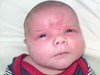 
<p><strong>Angel kiss/ Salmon patch</strong> on forehead at 5
weeks. Completely vanished by the age of 2 years.</p>
