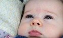 
<p>Angel kiss on forehead, now nearly a year and fading
gradually.</p>
