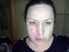 
<p><span><strong>Capillary malformation (port wine
stain)</strong>&nbsp;<br />
 On the right side of face. Started laser treatment with argon
laser aged 11 (now age 33). Lots of stints of pulse dye laser, on
and off for maybe 15 yrs.&nbsp;</span> <span>Last treatment was
approximately 2/3 yrs ago.<br />
 <strong>1 of 2 &nbsp;</strong></span></p>

