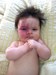 
<p><strong>Capillary malformation (port wine stain)</strong><br />
On the right side of face. This picture was taken at 4 months. She
will undergo laser treatment around her 1st Birthday.<br />
 <strong>2 of 2&nbsp;</strong></p>
