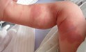 
<p><strong>Congenital haemangioma</strong><br />
On the right leg. Picture taken 24 hours old.&nbsp;<br />
 <strong>1 of 3 &nbsp;</strong></p>
