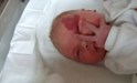 
<p><strong>Capillary malformation (port wine stain)<br />
</strong>On the right eyelid. Picture taken when less than 24 hours
old.<br />
 <strong>1 of 2&nbsp;</strong></p>
