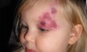 
<p><strong>Capillary malformation (port wine stain)<br />
</strong>On the right eyelid. Picture taken at
2.5yrs.&nbsp;<span>Just out of theatre after having pulsed dye
laser treatment, 4 test patches at different strenghts. This was
treatment number 3.<br />
</span> <strong>2 of 2</strong></p>
