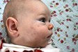 
<p><strong>Venous malformation<br />
</strong> Approximate age in photo 6 weeks. VM darkening since
birth. No treatment being given at this point.<br />
 <strong>1 of 6</strong></p>
