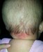 
<p>Stalk bite on nape of neck. Faded slightly since birth but now
being covered by hair.</p>
