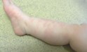 
<p><strong>Congenital haemangioma&nbsp;<br />
</strong> On the right leg. Picture taken at 1
year.&nbsp;<span>Birthmark has faded significantly with no
treatment.<br />
</span> <strong>3 of 3</strong></p>
