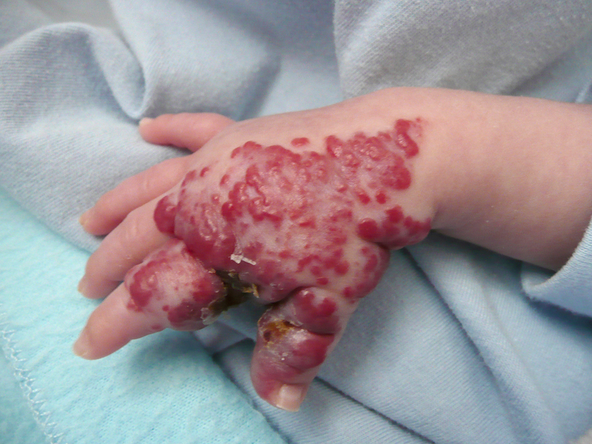 Propranolol (Infantile Hemangioma): MedlinePlus Drug ...