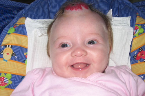 Infantile hemangiomas | Children's Hospital of Wisconsin