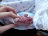
<p><strong>Haemangioma on the hand<br />
</strong> Faint mark noticed at 2 weeks and rapidly went through
the proliferative phase. This photograph shows the haemangioma at
approximately 11 weeks old.<br />
 <strong>1 of 4&nbsp;</strong></p>
