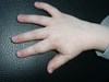 
<p><strong>Haemangioma on the hand<br />
</strong>Age 3 years. Involuted naturally, swelling almost gone.
Amazing result.<br />
 <strong>4 of 4 &nbsp;</strong></p>

