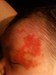
<p><strong><strong>Haemangioma of l</strong><strong>eft side of
face<br />
</strong></strong>Appeared very quickly between one and two weeks.
Growing daily. Photograph taken at 2 weeks. Immediate action was
taken by parents to get referal to a <a href="/{localLink:1331}"
title="Getting a referral">specialist</a>&nbsp;when realised that
her eye was being effected.&nbsp;<br />
 <strong>2 of 4</strong></p>
