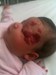 
<p><span><span><strong>Haemangioma of l</strong><strong>eft side of
face<br />
</strong>Photograph taken at 7 weeks. The 8 week wait to be seen by
a general <span>paediatrician by their G.P</span>&nbsp;was not
acceptable as it was growing so rapidly closing the eyelid and
becoming very raised. Parents went to a&nbsp;<span>private
dermatologist who routed them to the paediatric dermatologist at
Leeds General Infirmary. Propraolol started.<br />
 <strong>3 of 4 &nbsp;</strong></span></span></span></p>
