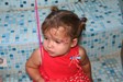 
<p><span><strong>Haemangioma of l</strong><strong>eft side of
face<br />
</strong>Photograph taken at 20 months. Haemangioma almost flat and
significantly reduced in size. Propranolol still taken.<br />
 <strong>4 of 4&nbsp;</strong></span></p>
