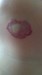 
<p><strong>Haemangioma&nbsp;under chin<br />
</strong>Photograph taken at 2 years 4 months. Not undergoing any
treatment taking the 'wait and see' approach. Multiple
haemangiomas.<br />
 <strong>1 of 3</strong></p>
