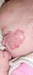 
<p><strong>Haemangioma&nbsp;on face<br />
</strong>Photograph taken at 11 months. Amazing results.<br />
 <strong>6 of 7</strong></p>
