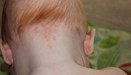 
<p><strong>Stalk mark</strong> on the nape of the neck</p>
