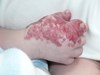 
<p><strong>Haemangioma on the hand.</strong><br />
Ulceration healed with the help of GOSH treatment plan, <a
href="http://www.gosh.nhs.uk/medical-conditions/procedures-and-treatments/cleaning-and-dressing-ulcerated-haemangiomas/"
 target="_blank">looking after an ulcerated haemangioma</a>.
Photograph taken at approx 4 months. Haemangioma starting to
involute without medication.<br />
 <strong>3 of 4 &nbsp;</strong></p>
