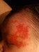 
<p><strong><strong>Haemangioma of l</strong><strong>eft side of
face<br />
</strong></strong>Appeared very quickly between one and two weeks.
Growing daily. Photograph taken at 2 weeks. Immediate action was
taken by parents to get referal to a <a href="/{localLink:1331}"
title="Getting a referral">specialist</a>&nbsp;when realised that
her eye was being effected.&nbsp;<br />
 <strong>2 of 4</strong></p>
