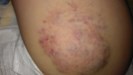 
<p><strong>Haemangioma on top of thigh<br />
</strong>Photograph taken at 2 years 4 months. Not undergoing any
treatment taking the 'wait and see' approach. Multiple
haemangiomas.<br />
 <strong>1 of 3&nbsp;</strong></p>
