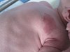 
<p><strong>Haemangioma on the chest<br />
</strong>Propranolol started at 5 months.<br />
 <strong>2 of 2&nbsp;</strong></p>
