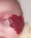 
<p><strong>Haemangioma on face<br />
</strong>Photograph taken at 6 weeks. No treatment started. Growing
very rapidly. Seen by specialist at John Radcliff Hospital, Oxford.
Propranolol about to start.<br />
 <strong>1 of 7&nbsp;</strong></p>
