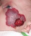 
<p><strong>Haemangioma&nbsp;on face<br />
</strong>Photograph taken at 11 weeks. Propranolol started.
Ulceration underway. GOSH guidelines being followed on&nbsp;<a
href="http://www.gosh.nhs.uk/medical-conditions/procedures-and-treatments/cleaning-and-dressing-ulcerated-haemangiomas/"
 target="_blank">treating an ulcerated haemangioma</a>.<br />
 <strong>4 of 5</strong></p>
