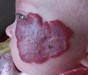 
<p><span><strong>Haemangioma&nbsp;on face<br />
</strong>Photograph taken at 14 weeks. Propranolol started.
Ulceration scab falls off leaving 'dented' area of skin.&nbsp;GOSH
guidelines followed on&nbsp;<a
href="http://www.gosh.nhs.uk/medical-conditions/procedures-and-treatments/cleaning-and-dressing-ulcerated-haemangiomas/"
 target="_blank">treating an ulcerated haemangioma</a>.<br />
 <strong>5 of 7</strong></span></p>
