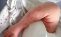 
<p><strong>Congenital haemangioma&nbsp;<br />
</strong> On the right leg. Picture taken 24 hours old.&nbsp;<br />
 <strong>2 of 3 &nbsp;</strong></p>

