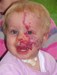 
<p><strong>Facial and sub-glottic haemangioma</strong><br />
 1st birthday. Still taking oral steroids.<br />
 <strong>4 of 4&nbsp;</strong></p>
