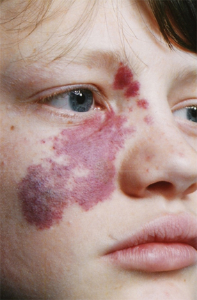 Birthmark Support Group